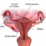 Significado de endometriose