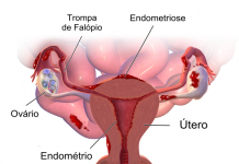 Significado de endometriose