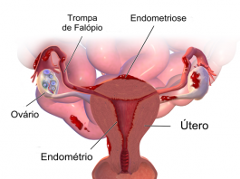 Significado de endometriose