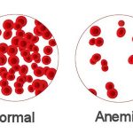 Anemia