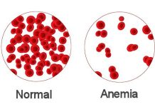 Anemia