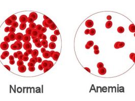 Anemia