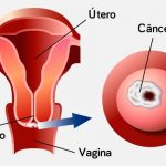 Cancro do colo uterino