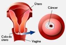 Cancro do colo uterino