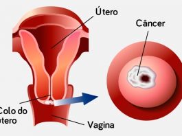 Cancro do colo uterino