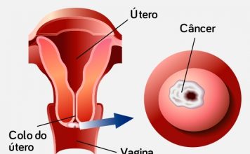 Cancro do colo uterino