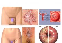 HPV - Virus do papiloma Humano