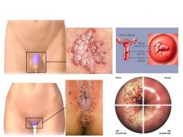 HPV - Virus do papiloma Humano