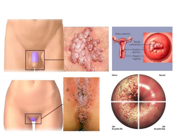 HPV - Virus do papiloma Humano