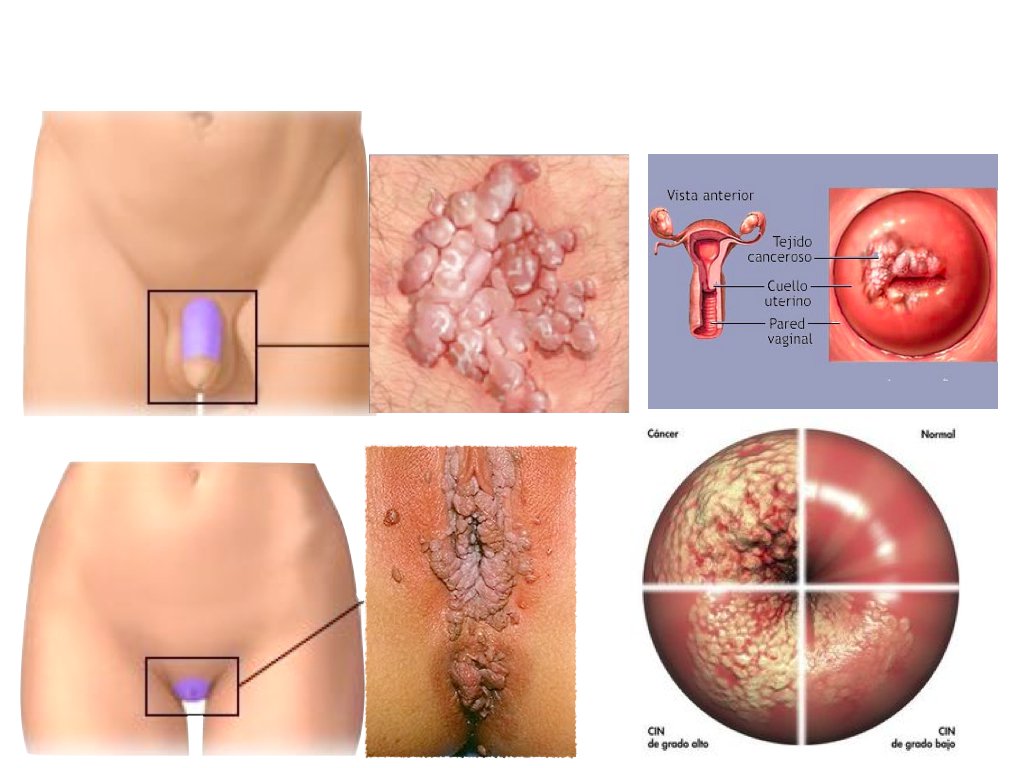 Was tun bei hpv virus - Traducere 