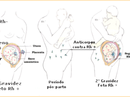 Imunoglobina especifica anti rh