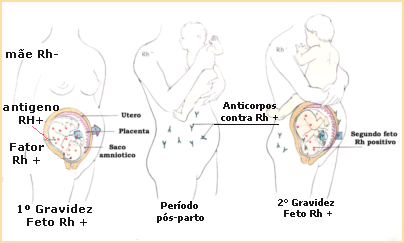 Imunoglobina especifica anti rh