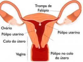 Pólipos uterinos