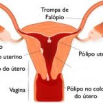 Pólipos uterinos