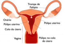 Pólipos uterinos