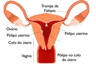 Pólipos uterinos