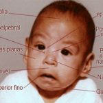 Sindroma de alcoolismo fetal