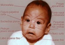 Sindroma de alcoolismo fetal