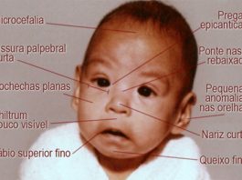 Sindroma de alcoolismo fetal