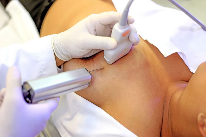 Biopsia mamária, um exame para detetar lesões na mama