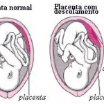 Descolamento da Placenta