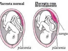 Descolamento da Placenta