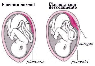 Descolamento da Placenta