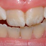 Fluorose dentária