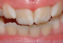 Fluorose dentária