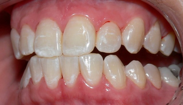 Fluorose dentária