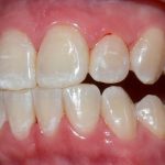 Fluorose dentária