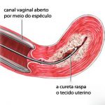 Raspagem uterina