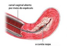 Raspagem uterina