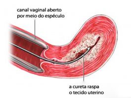 Raspagem uterina