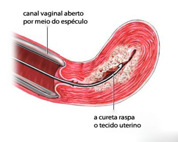 Raspagem uterina