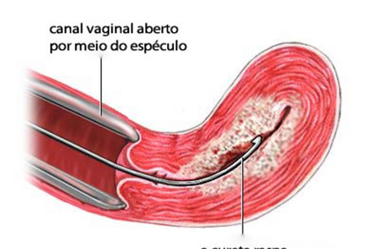 Raspagem uterina