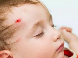 Lesões na cabeça do bebé provocadas por uma queda