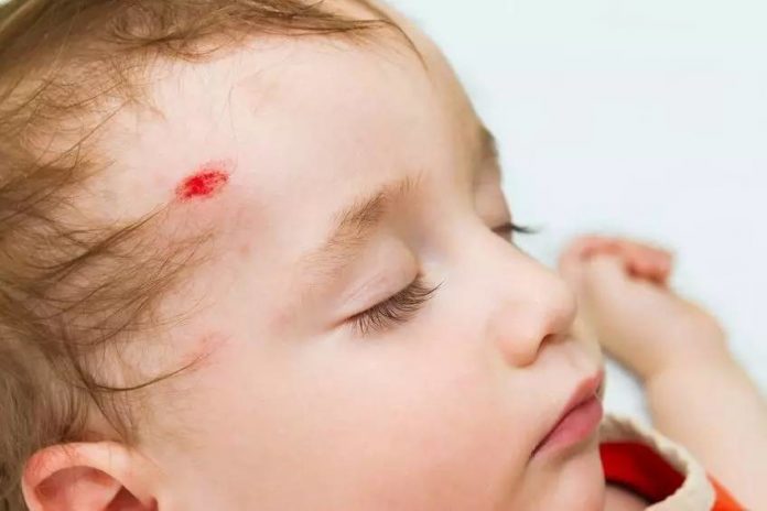 Lesões na cabeça do bebé provocadas por uma queda