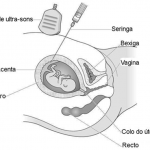 Biopsia da placenta