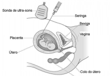 Biopsia da placenta