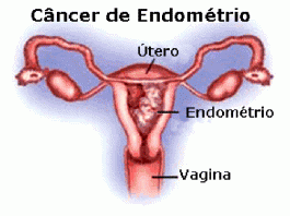 Cancro do endométrio, pode ser curável