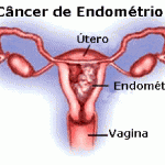 Cancro do endométrio, pode ser curável