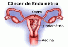 Cancro do endométrio, pode ser curável