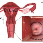 Colo uterino ou colo do útero