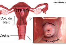 Colo uterino ou colo do útero