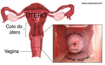 Colo uterino ou colo do útero