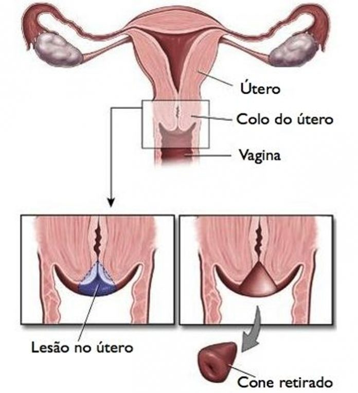 Conização do útero