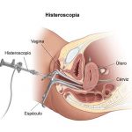 Histeroscopia