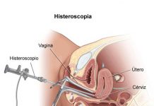 Histeroscopia