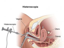 Histeroscopia